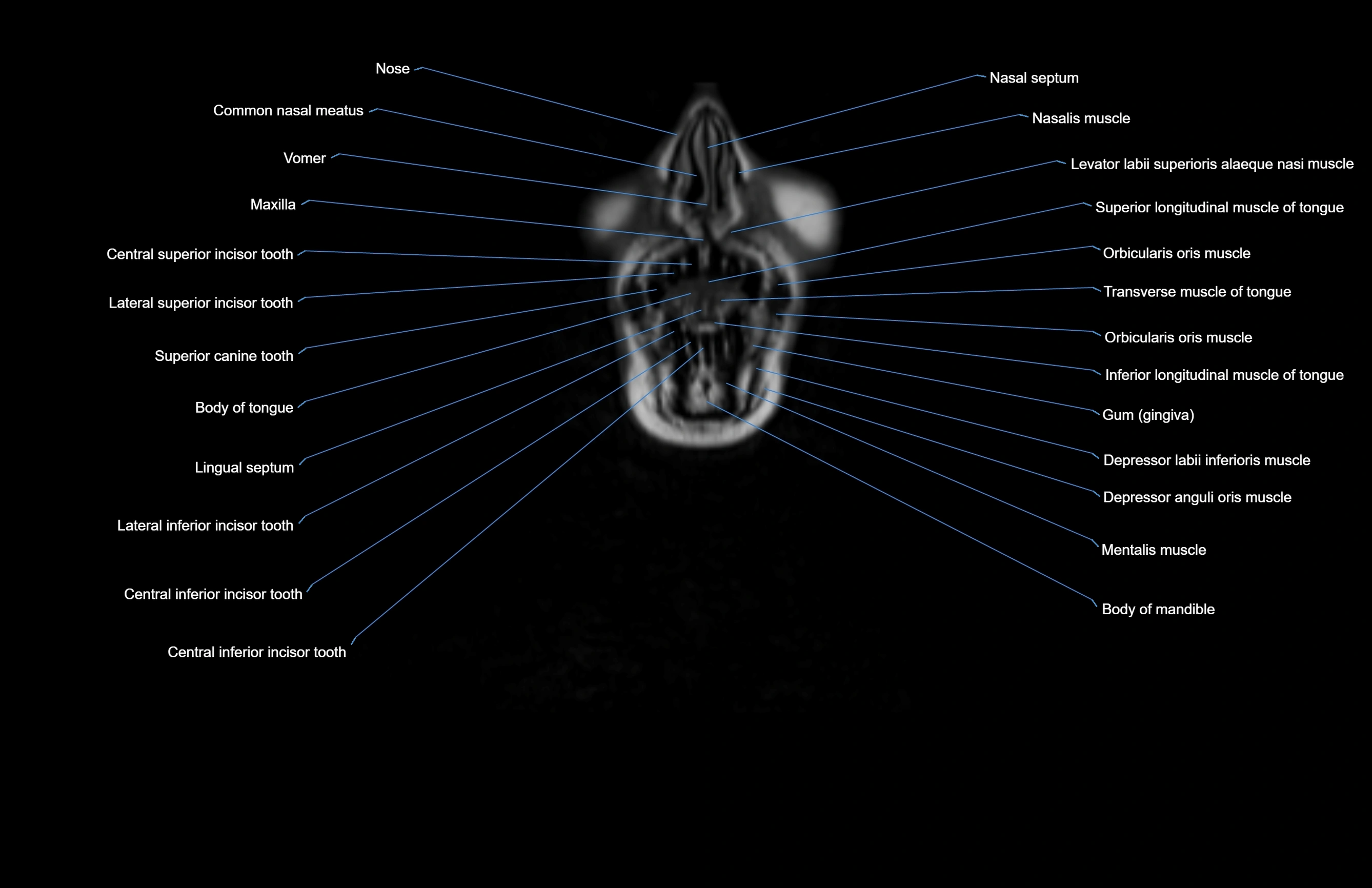 Neck coronal cross sectional MRI anatomy 3T MRI  image-img-00001-00075.webp